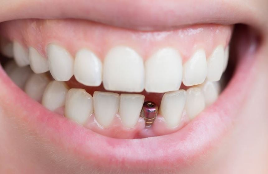 چگونه دندان را ایمپلنت میکنند؟
