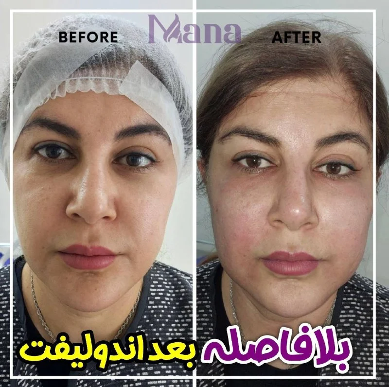 قبل و بعد اندولیفت