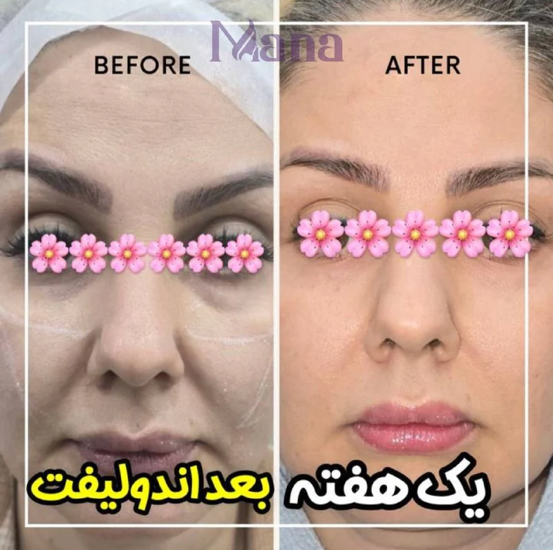 اندولیفت