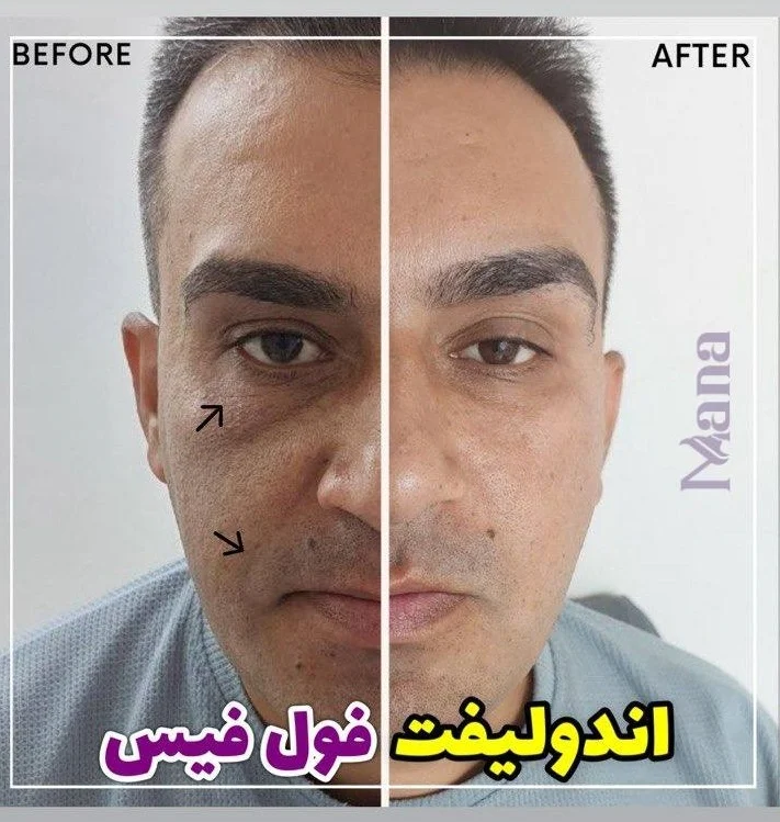 قبل و بعد اندولیفت