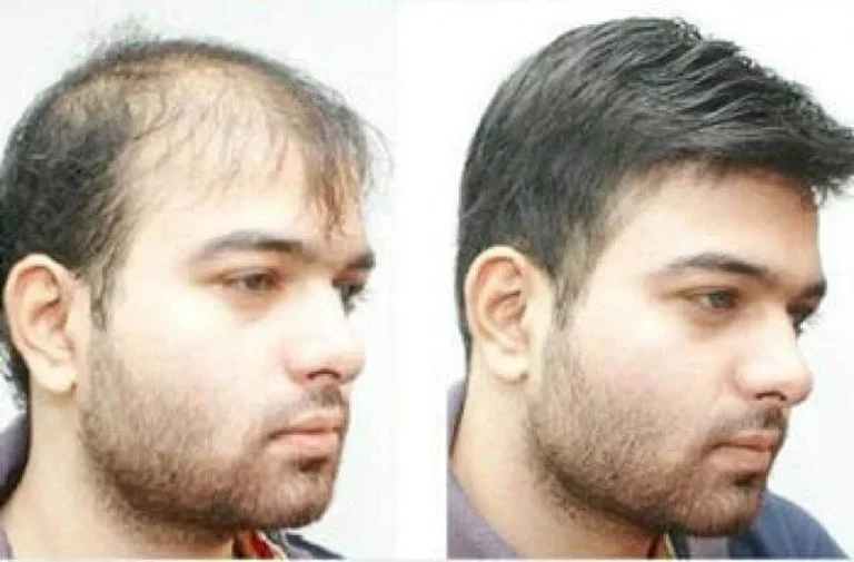 بهترین کلینیک های کاشت مو از نظر مردم کدامند