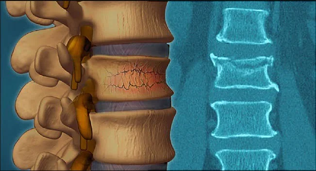 Lumbar fracture
