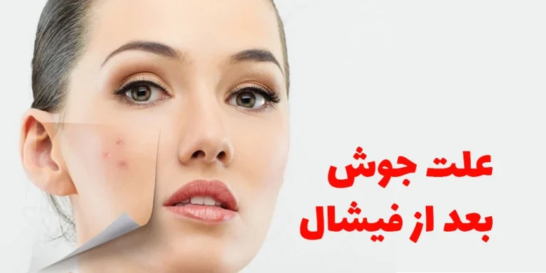 مراقبت بعد از فیشیال صورت